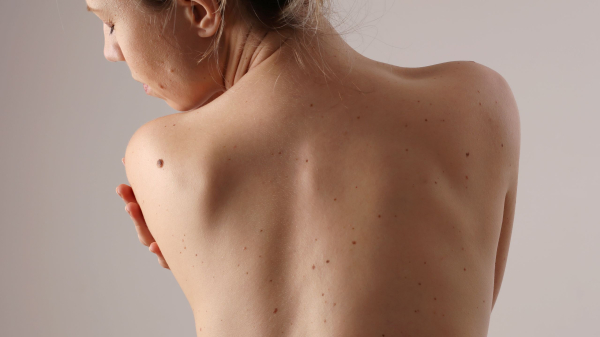 Invasive Melanoma Cases Have Risen Almost 50% Over the Past Decade